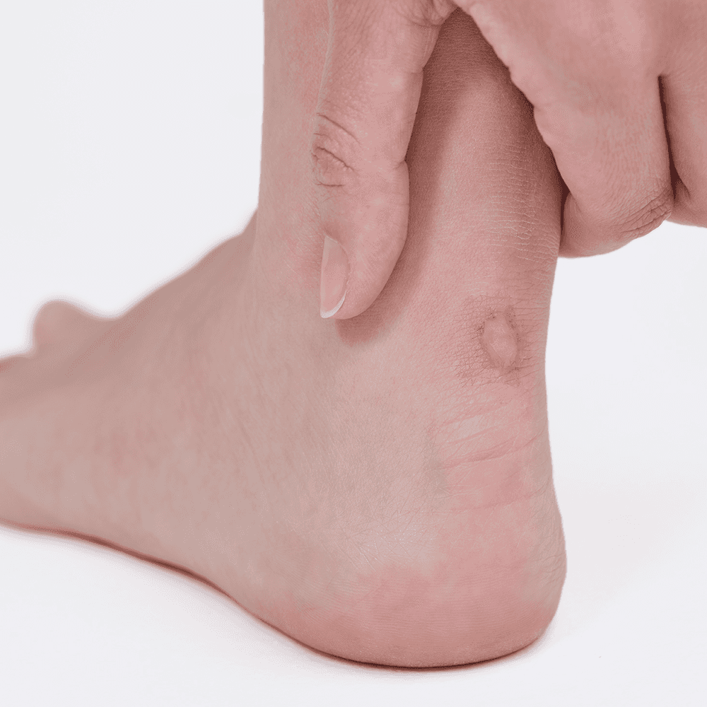 Blister on heel